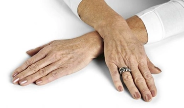 Eldeki Kahverengi Lekeler Belirtileri ve Tedavisi Eldeki Kahverengi Lekeler Belirtileri ve Tedavisi