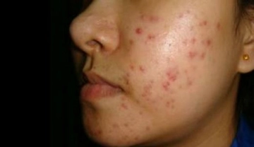 İbrahim Saraçoğlu Sivilce Lekeleri İbrahim Saraçoğlu Sivilce Lekeleri