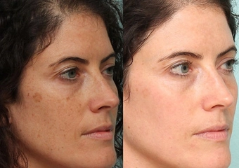 Yüzdeki Kahverengi Lekeler? Yüzdeki Kahverengi Lekeler?