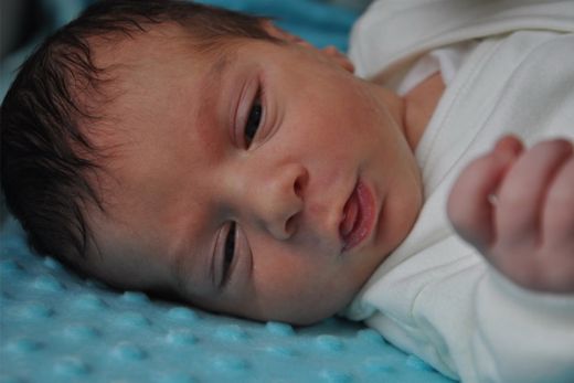 Bebeklerde Doğum Lekesi Nasıl Geçer